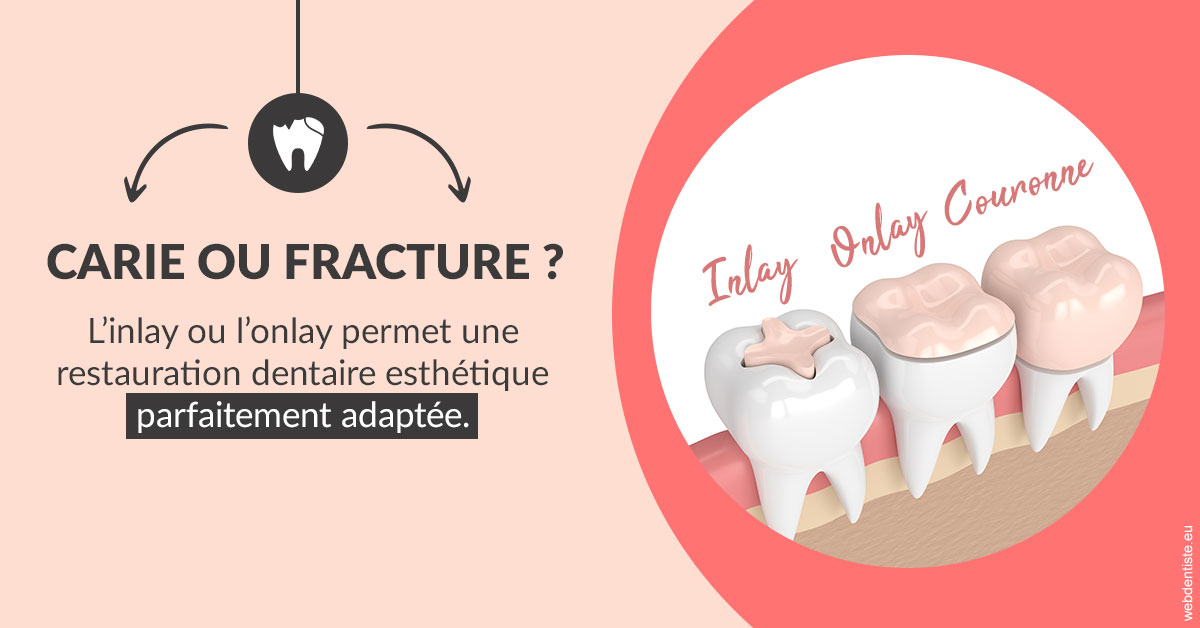https://dr-emmanuel-toucas.chirurgiens-dentistes.fr/T2 2023 - Carie ou fracture 2