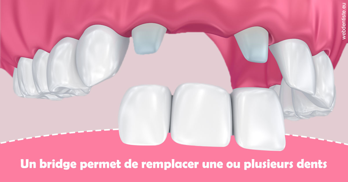https://dr-emmanuel-toucas.chirurgiens-dentistes.fr/Bridge remplacer dents 2