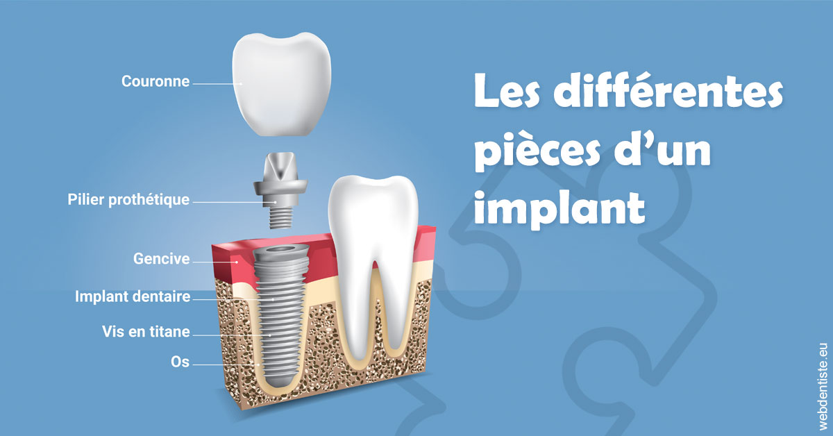 https://dr-emmanuel-toucas.chirurgiens-dentistes.fr/Les différentes pièces d’un implant 1